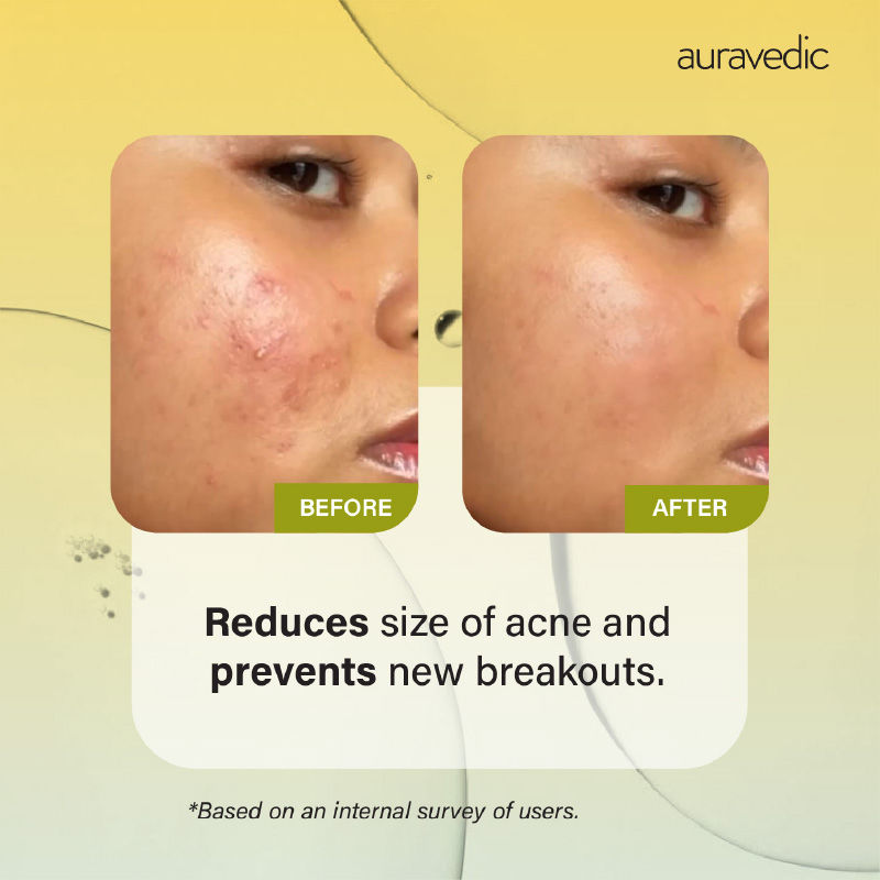 Tea Tree Oil Salicylic acid Face Serum for Acne Prone Skin Pore Minimizing Serum