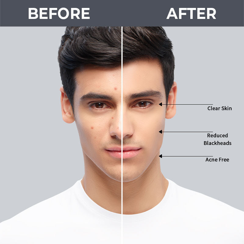 Nykaa SKINRX 2% Salicylic Acid Face Serum For Acne, Blackheads, Whiteheads & Clear Skin