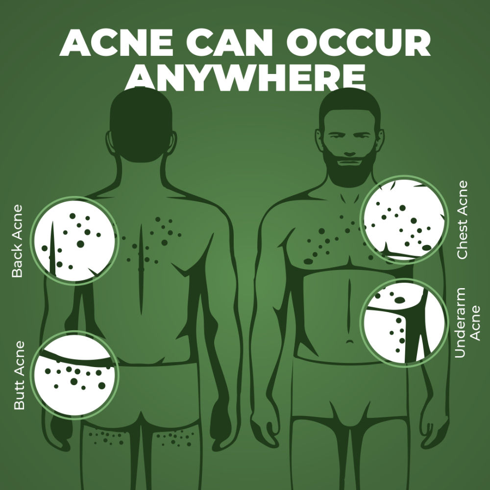 B-Acne Clear Bathing Bar