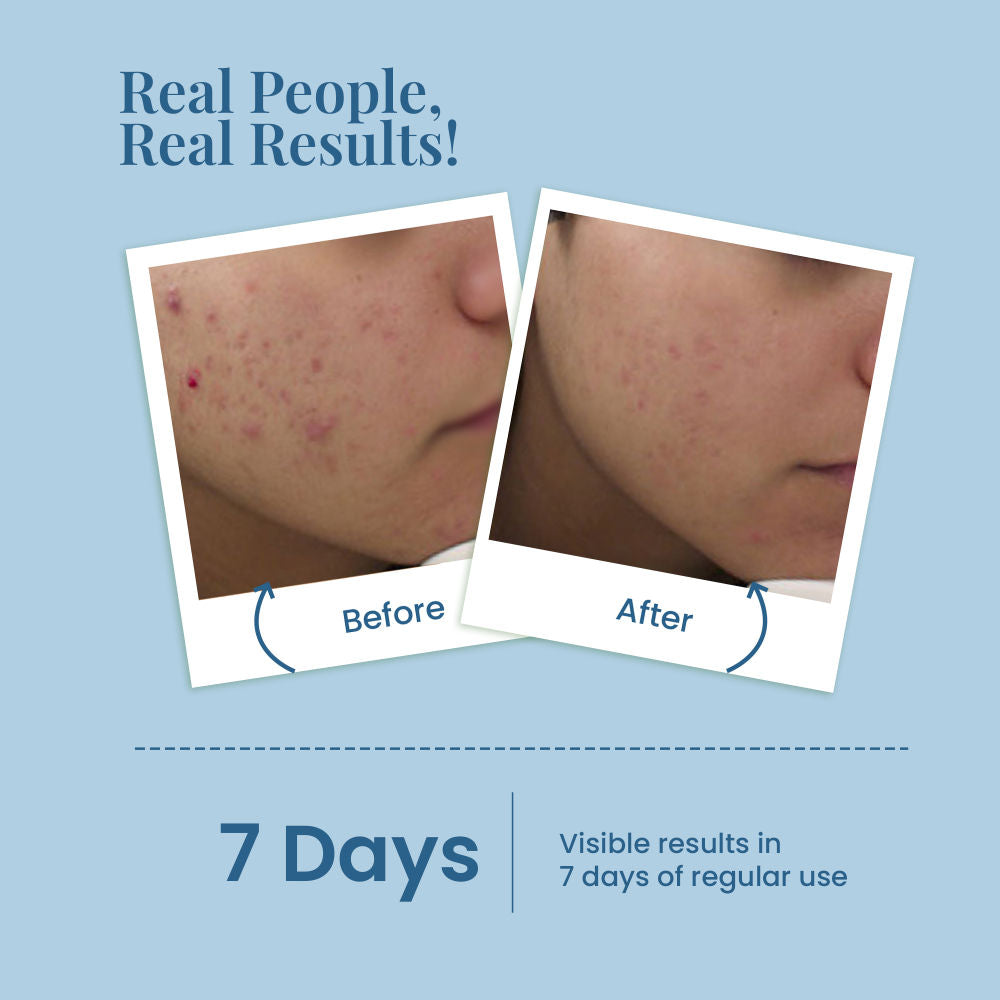 Acne & Pore Perfection Daily Face Wash For Acne Prone & Oily Skin