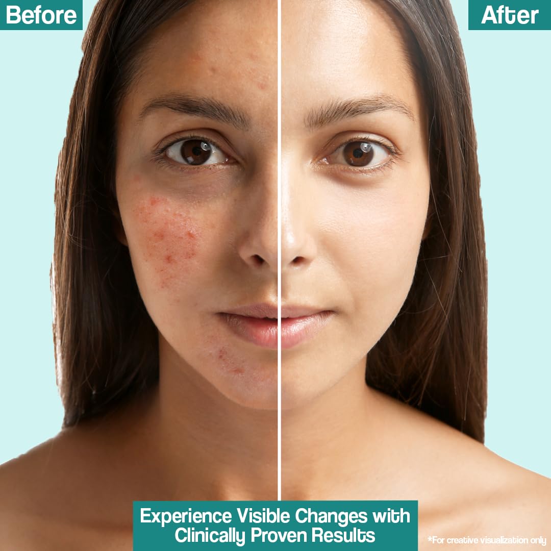 Acne Control Moisturizer| Oily Skin Friendly| Lightens Acne Scars|75g