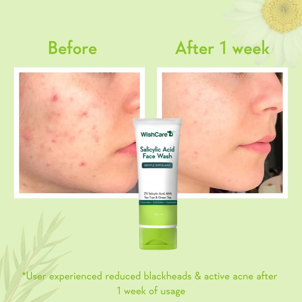 2% Salicylic Acid Face Wash with AHA, Greentea & Tea Tree -Oil Control-Reduces Sebum & Acne