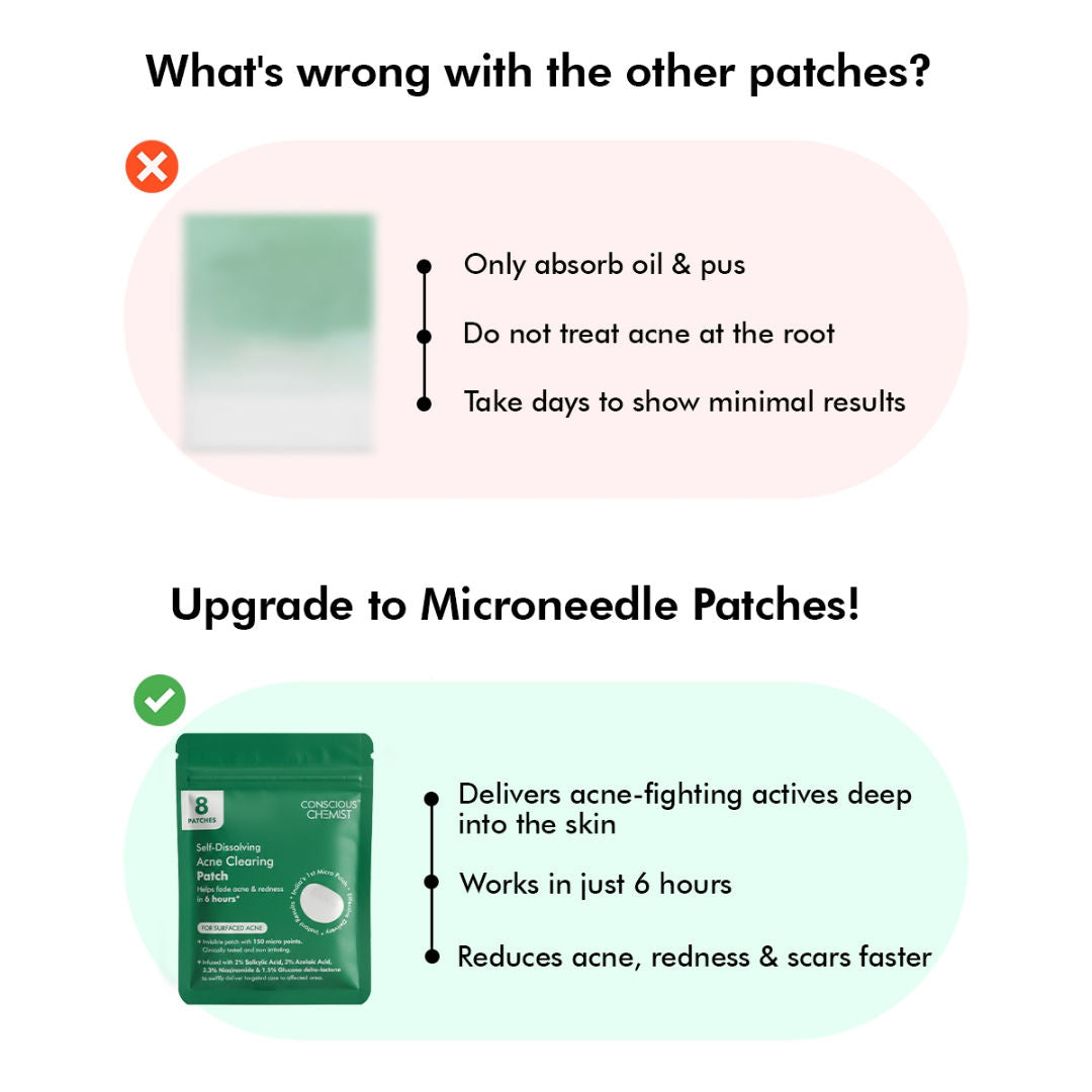 Self Dissolving Microneedle Acne Patches