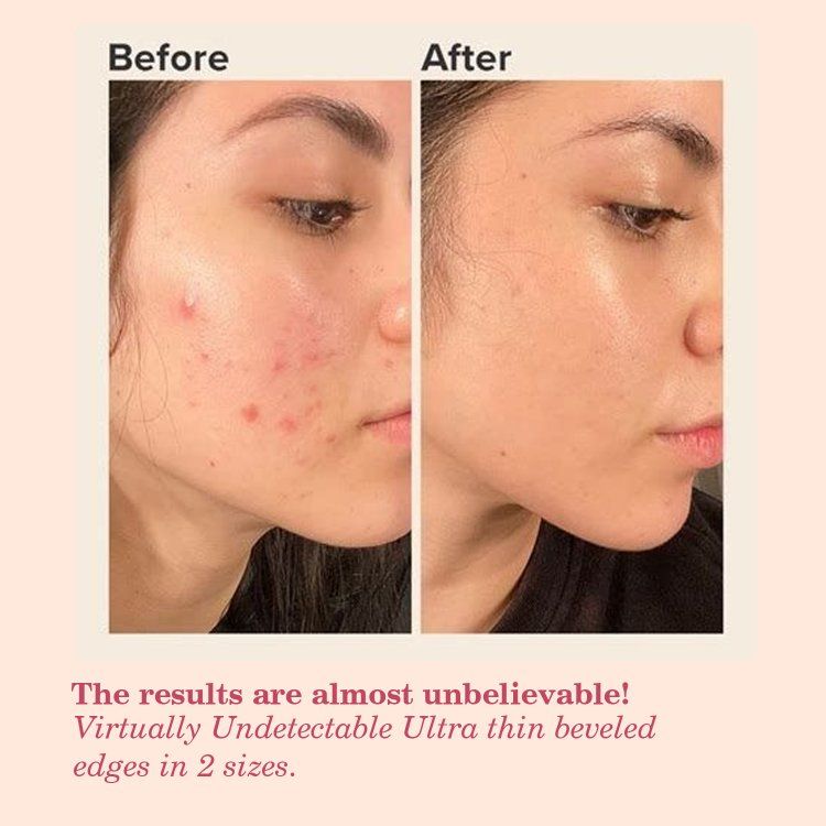 Acne Pimple Patches