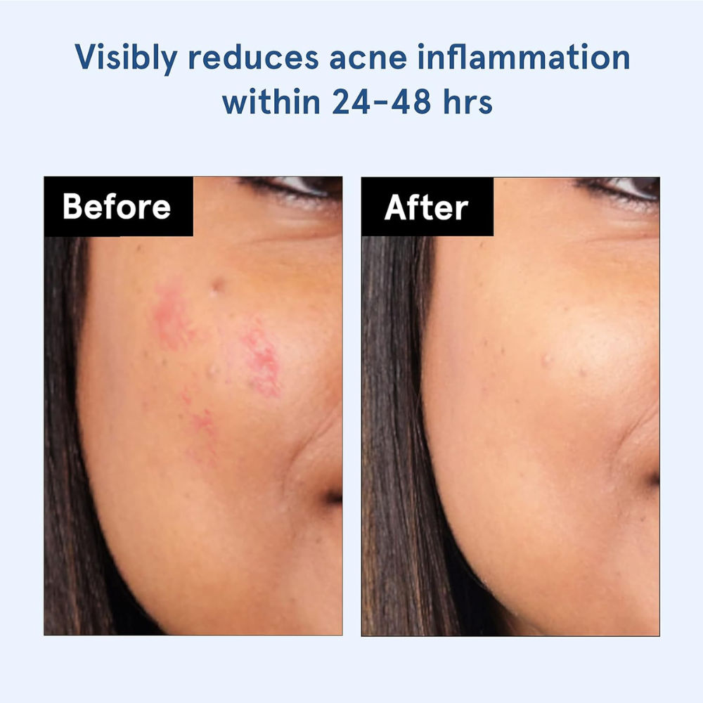 Hydrocolloid Acne Pimple Patch Absorbs & Flattens Acne Overnight