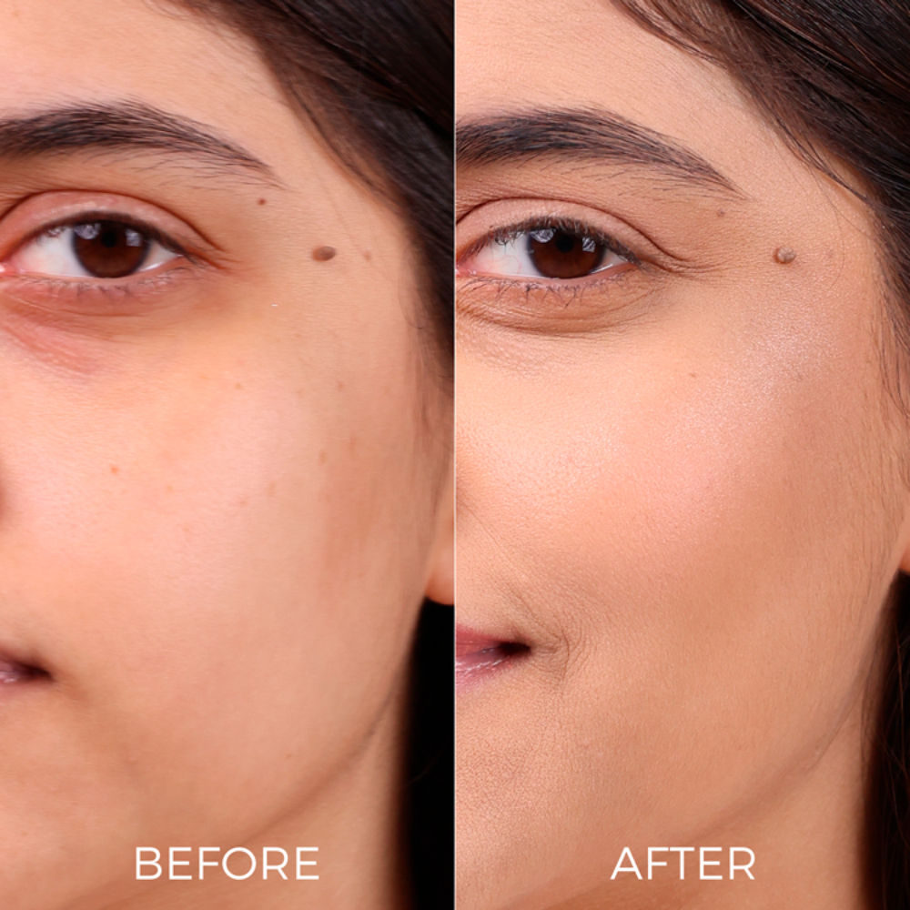 2% Salicylic Acid Face Serum for Acne & Dark Spots Visible Acne Reduction in 7 Days