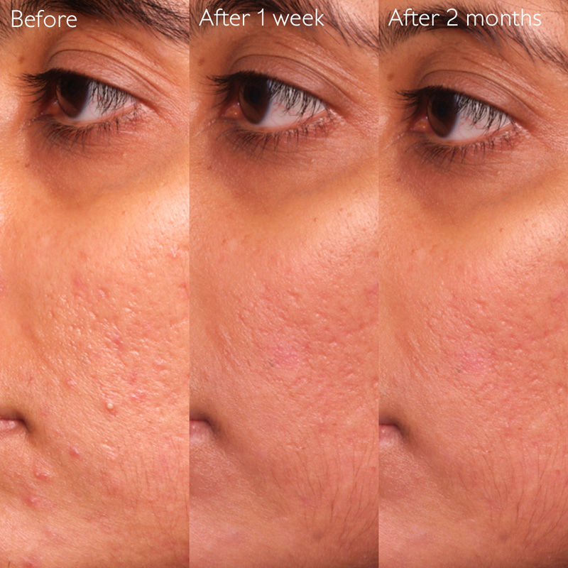 Vinopure Blemish Control Salicylic Serum
