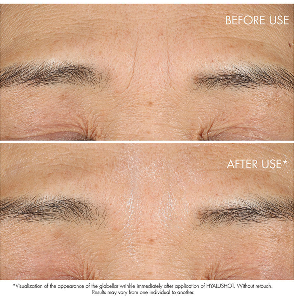 Capture Totale Hyalushot Wrinkle Corrector