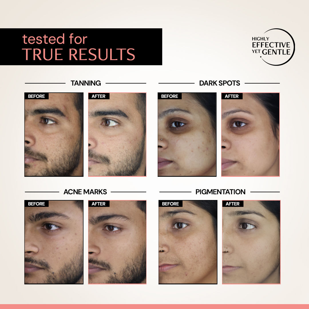 5% Niacinamide Face Serum with Alpha Arbutin, For Acne Marks, Beginner Friendly