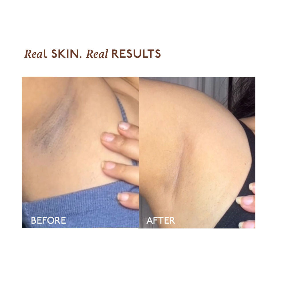 Depigmentation Underarm Spray for Dark Underarms with MelaMe Complex
