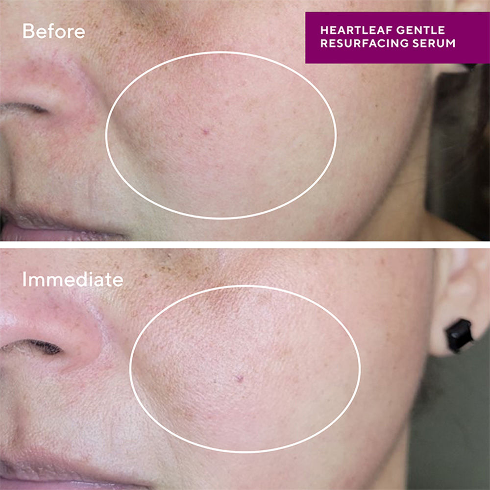 Sensitive Skin Heartleaf Gentle Resurfacing Serum