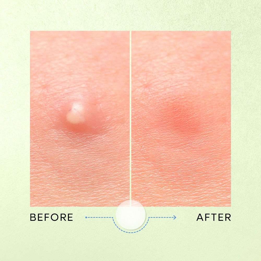 Secrets Tea Tree & Salicylic Acid Korean Acne Spot Patch-Fast Acne Healing (12 pcs)