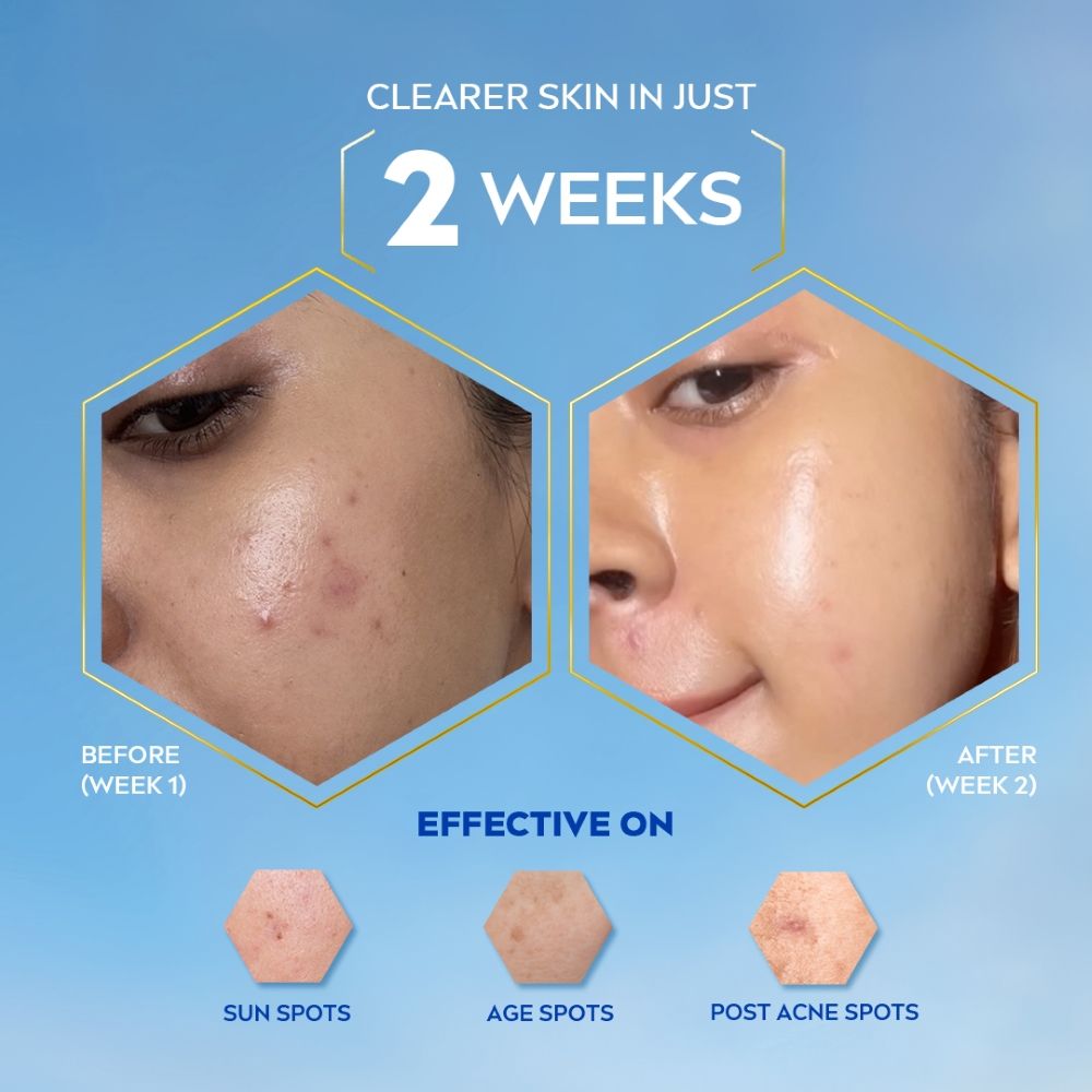 Luminous Even Glow Oil Control Serum Thiamidol, Salicylic, Hyaluronic Acid Reduces Dark Spot