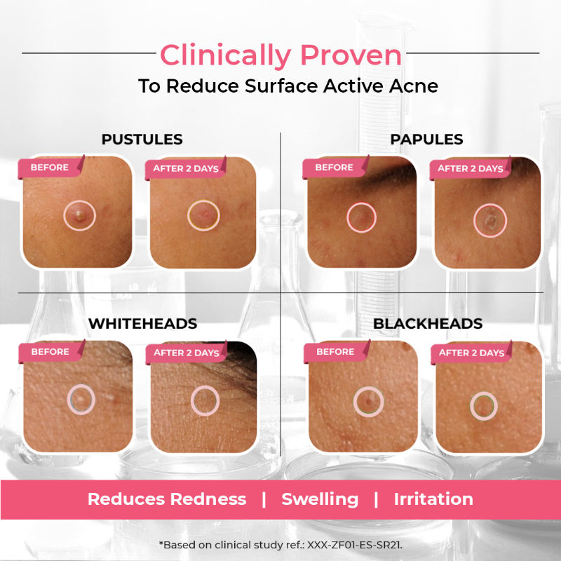Overnight Acne Spot Corrector