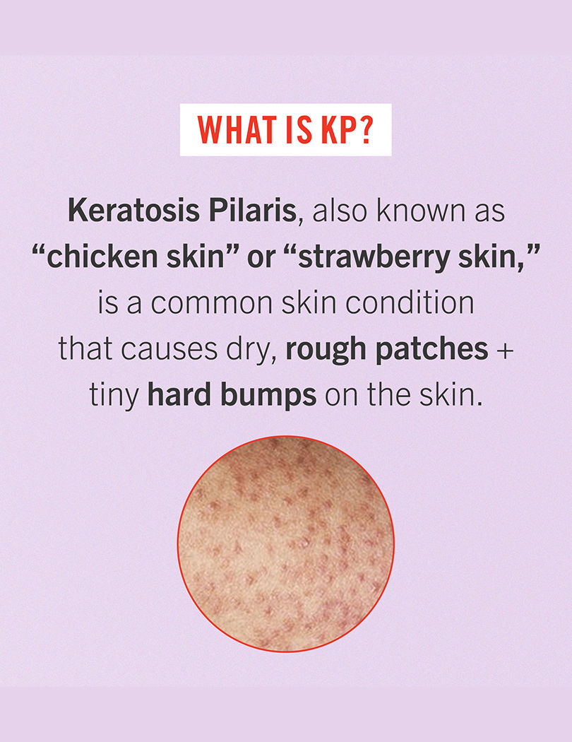 KP Bump Eraser Body Scrub With 10% AHA