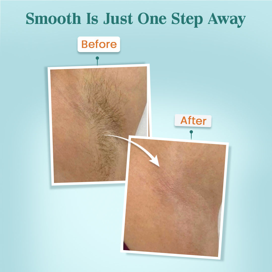 Intimate Hair Removal Cream Easy & Gentle Hair Removal Solution