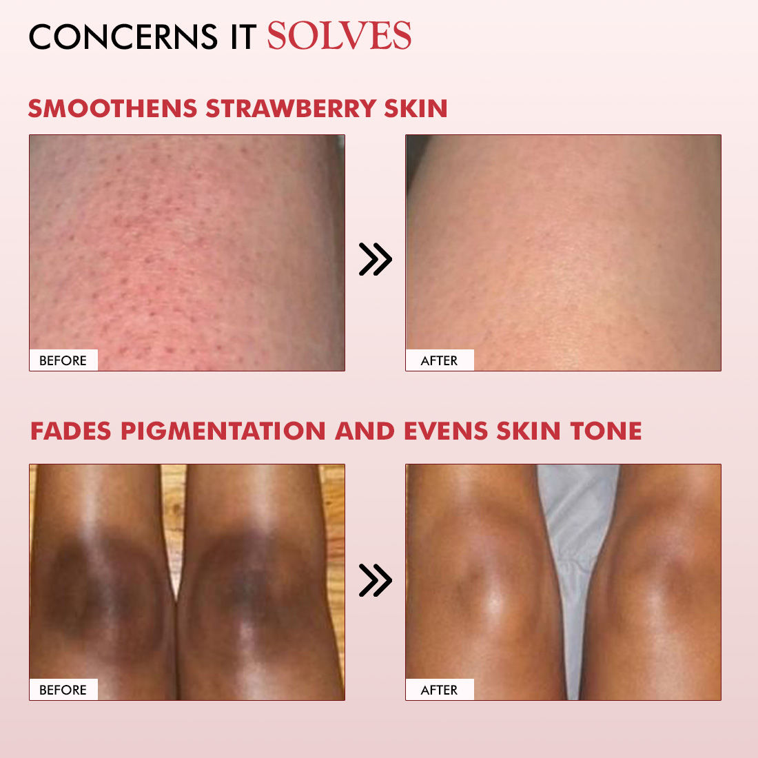 11% AHA BHA Strawberry Body Lotion for Smooth Skin, Gently Exfoliates, 72H Moisturization
