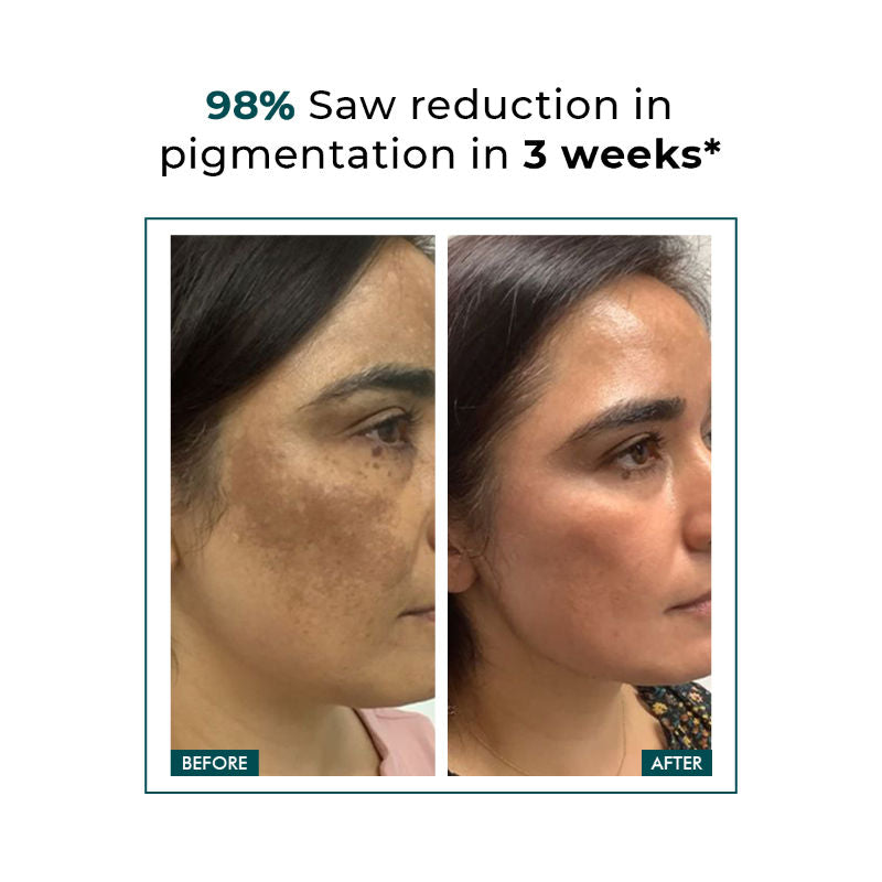 Trubiom 5% Niacinamide Serum + 1% Zinc Improves Acne Scar & Uneven Skin Texture