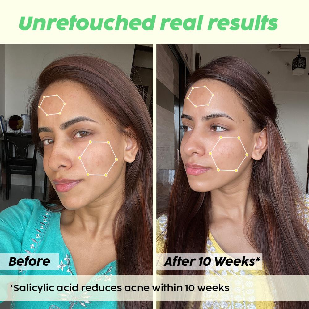 0.5% Salicylic Acid Jamun Face Wash Cleanser For Active Acne & Oil Control, Acne Breakouts