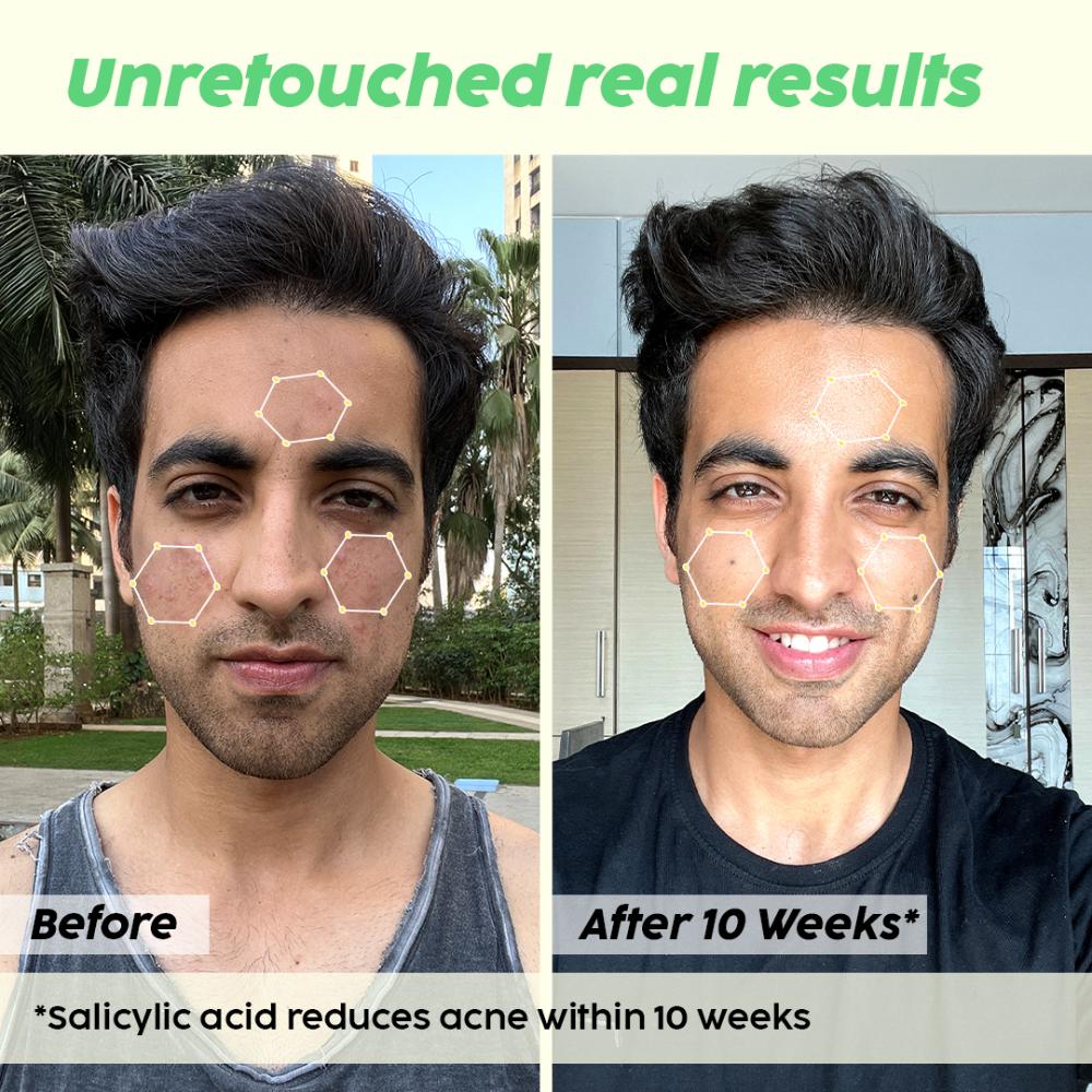 0.5% Salicylic Acid Jamun Face Wash Cleanser For Active Acne & Oil Control, Acne Breakouts