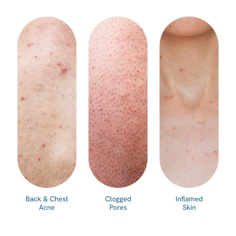 2.5% Benzoyl Peroxide Body Wash Treats Stubborn Back Acne