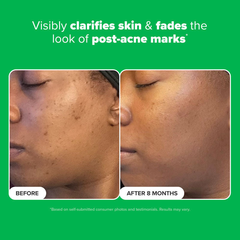 Boost 10% Azelaic Acid Booster