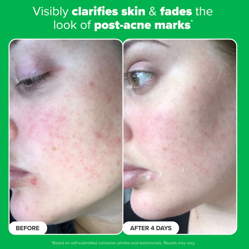 Boost 10% Azelaic Acid Booster
