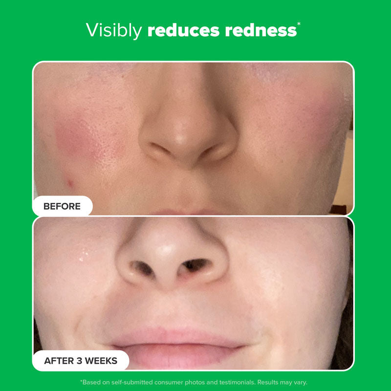 Boost 10% Azelaic Acid Booster
