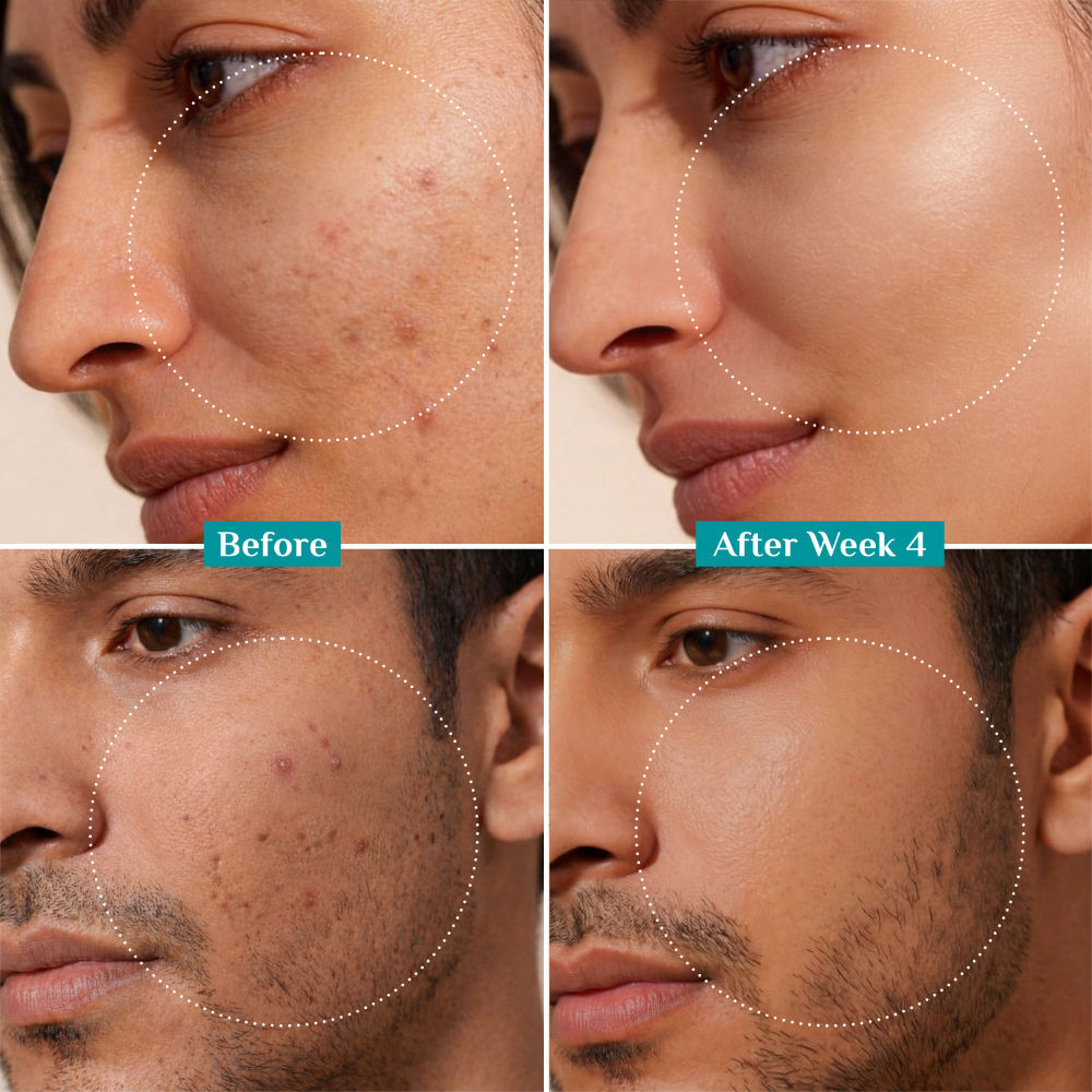 10% Niacinamide Face Serum For Acne Marks