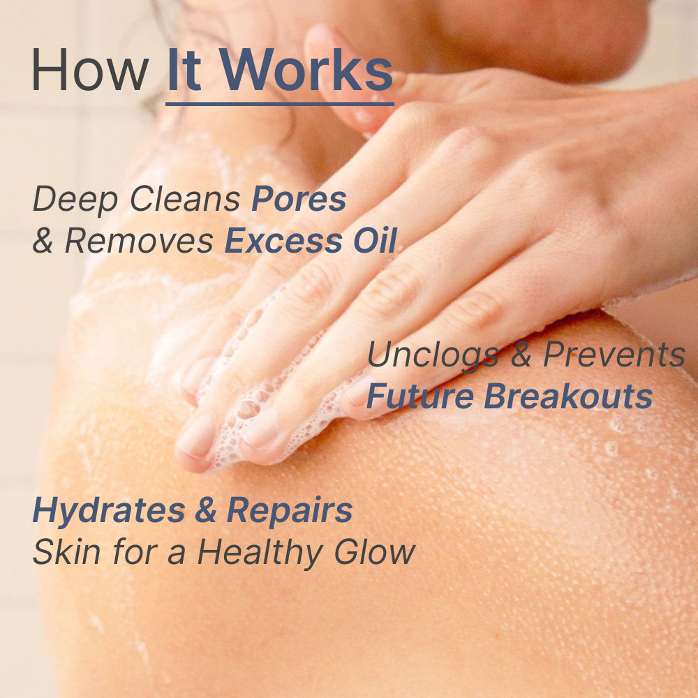5% Benzoyl Peroxide Face & Body Acne Wash