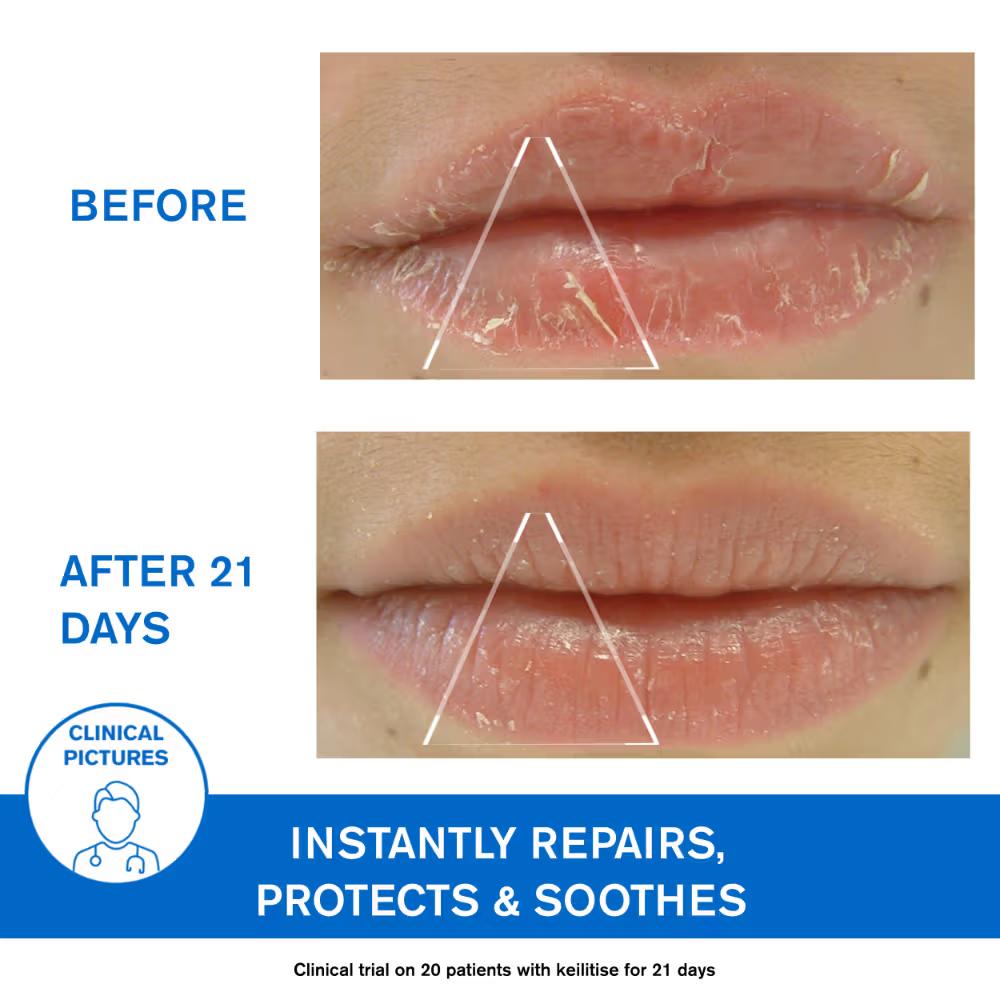 Bariederm-Cica Protecting Dermat Recommended Lip Balm Repairs Soothes Chapped Damaged Lips