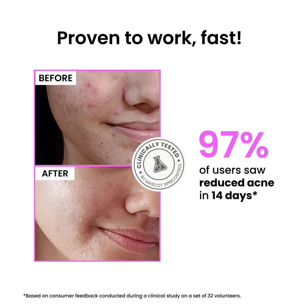 12% Niacinamide Brightening Face Serum, Fades Dark Spots, Acne marks & Oil Control