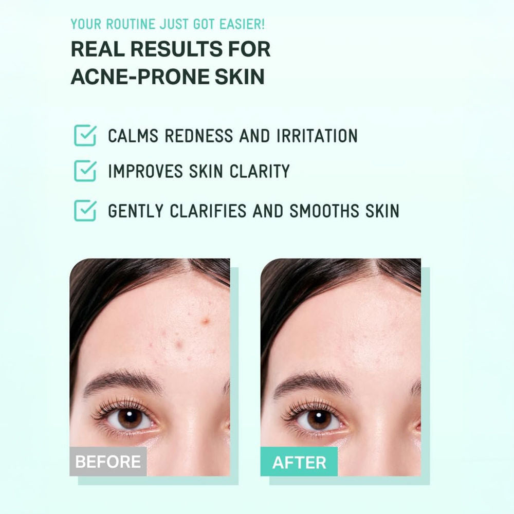 Tea Tree Cica Soothing Korean Toner, For Acne-Prone & Sensitive Skin