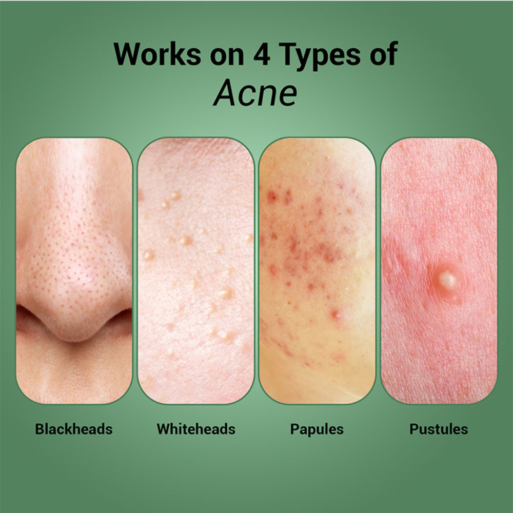 Oil Clear Face Moisturizer with Lactic Acid & NMF for Oily, Acne-Prone & Combination Skin