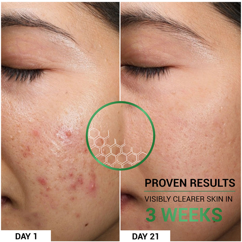 Oil Clear Face Moisturizer with Lactic Acid & NMF for Oily, Acne-Prone & Combination Skin