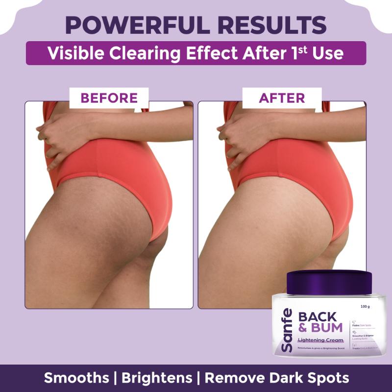 Back & Bum Cream For Dark Spots And Body Acne
