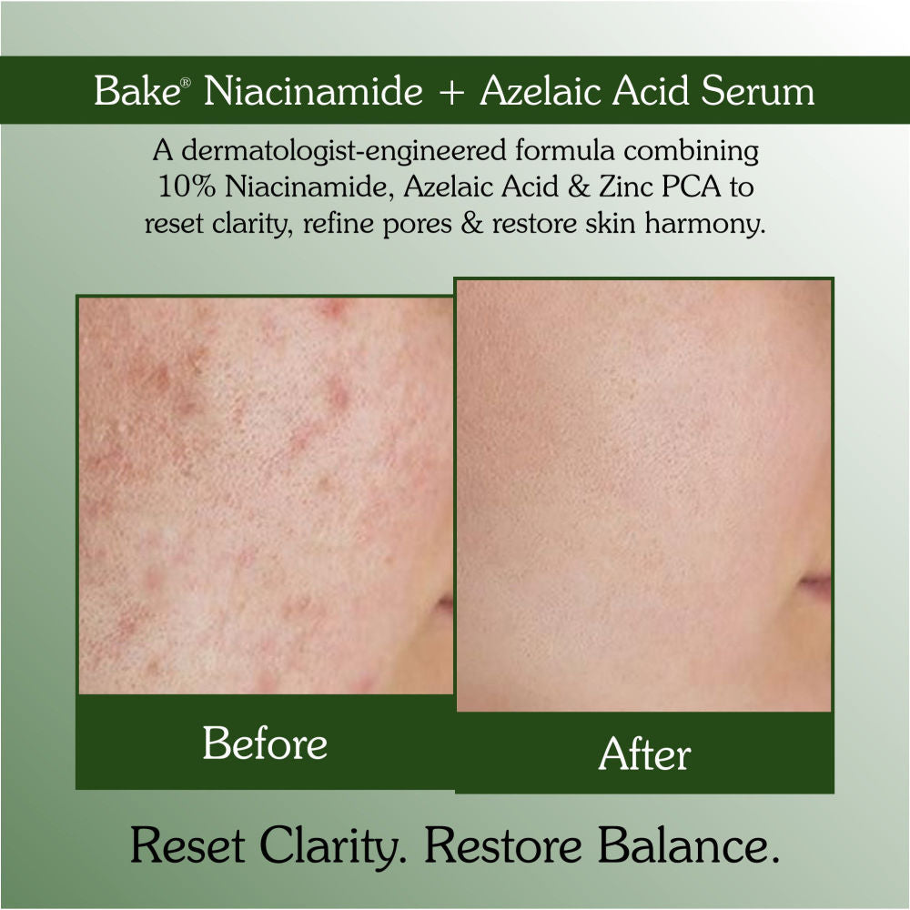 10% Niacinamide & Azelaic Acid Face Serum For Acne Scars & Dark Spots