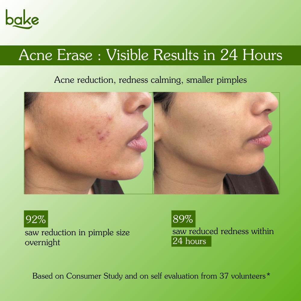 Acne Spot Serum Gel - Overnight Corrector For Pimples, Breakouts, Redness & Clogged Pores