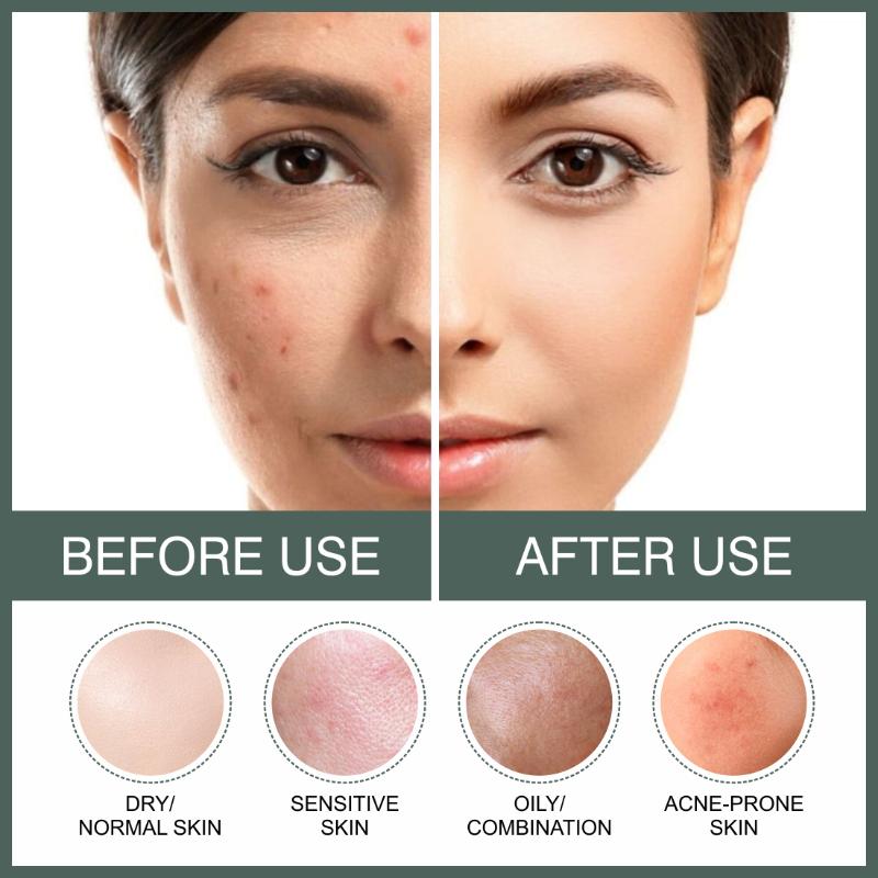 2% Salicylic Acid Serum For Face For Active Acne
