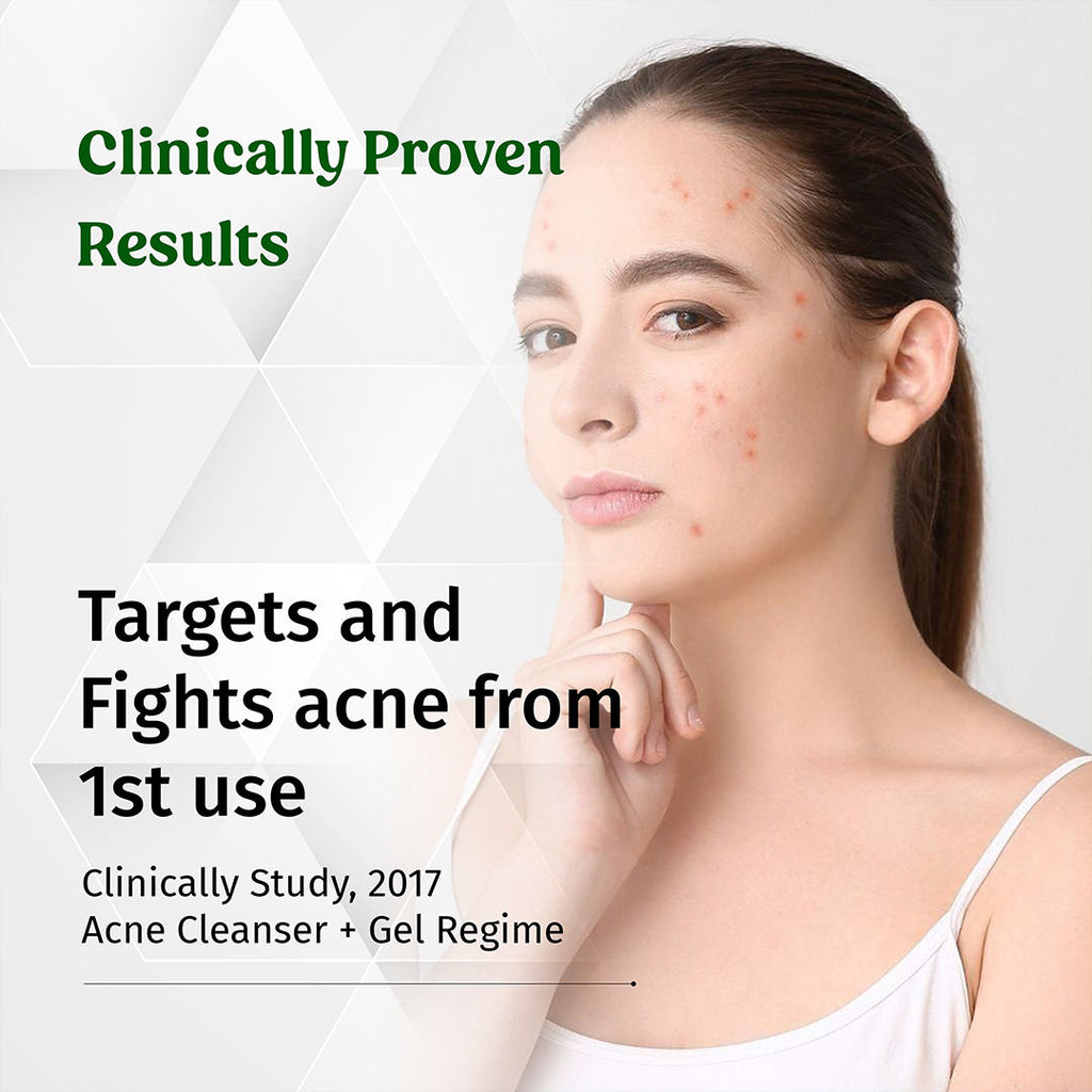 Acne Away Gel Anti Acne Face Gel
