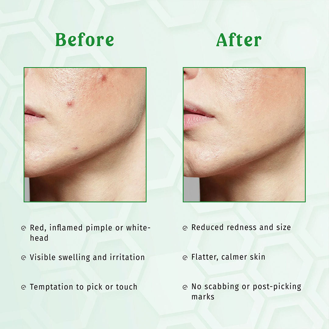 Clear Cue Acne Patches Overnight Pimple Solution