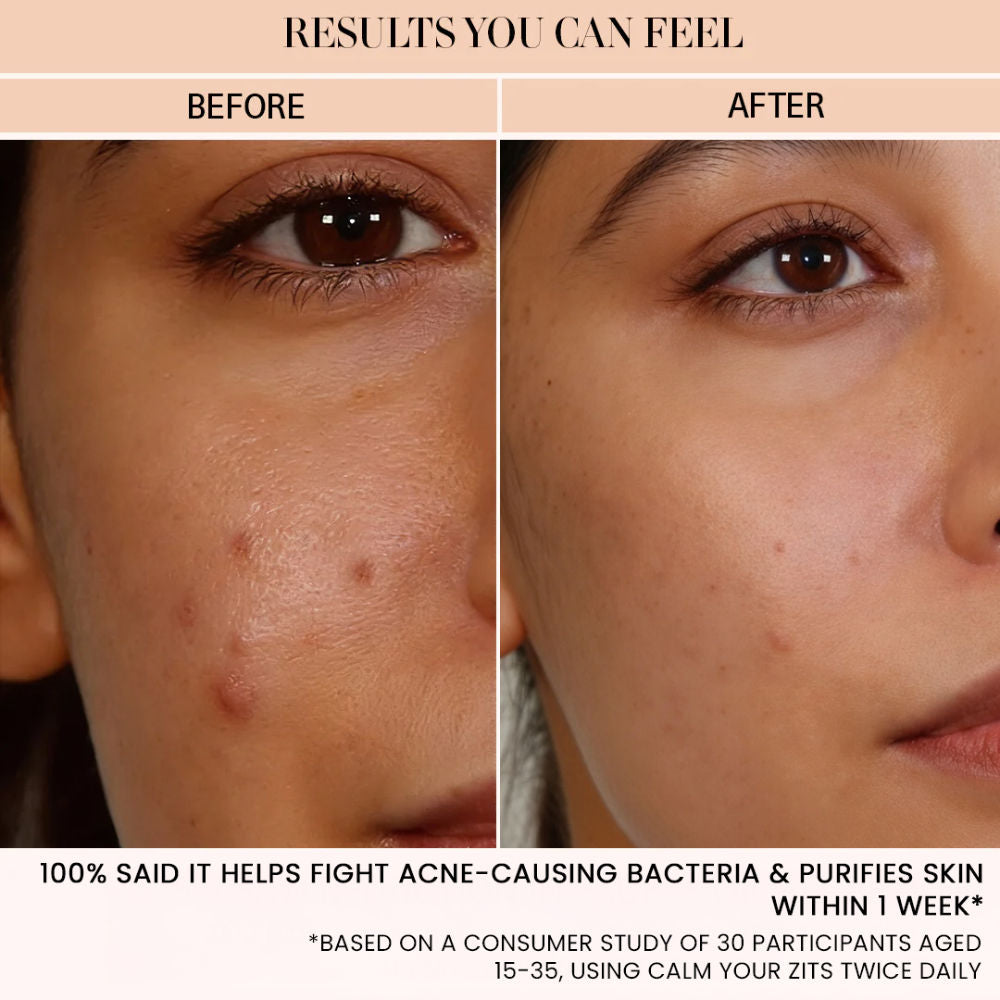 BiE Calm Your Zits - Anti Acne Gel for Spot Correction and Pimple Marks