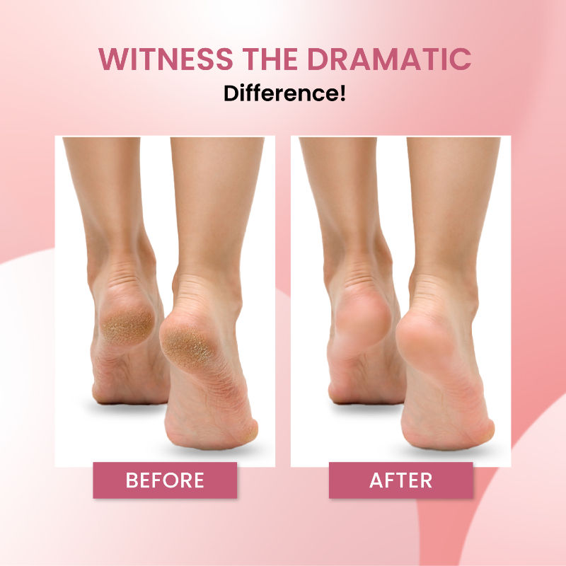 Electric Callus Remover
