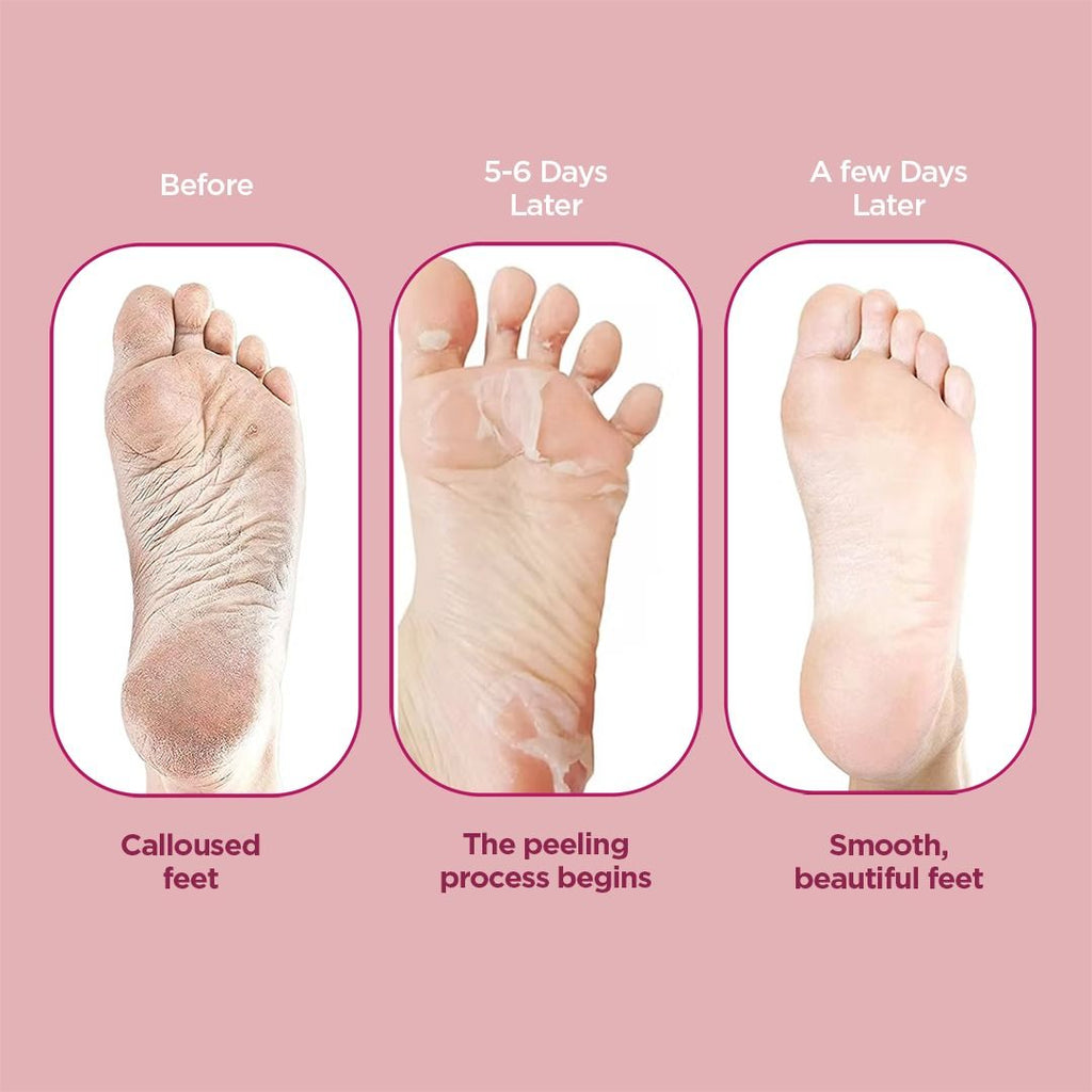 Glycolic & Salicylic Acid Exfoliating Foot Peeling Mask - Reduces Dry Skin