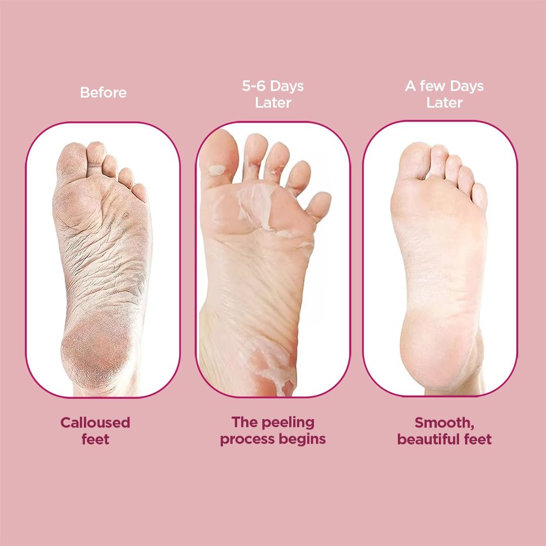 Glycolic & Salicylic Acid Exfoliating Foot Peeling Mask - Reduces Dry Skin