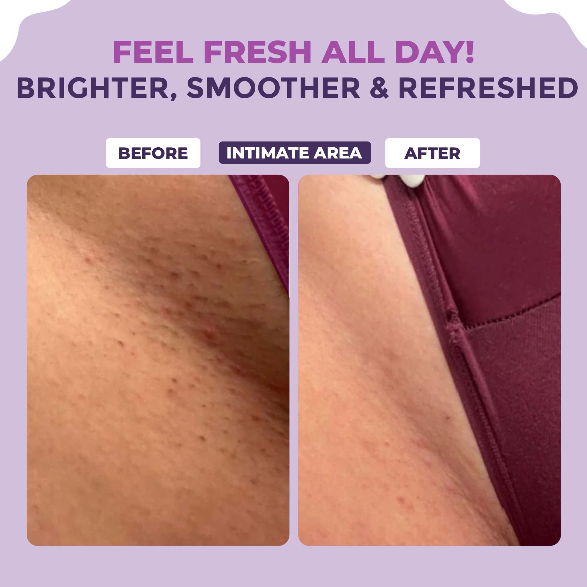 Spotlite Sensitive Body Serum For Dark Underarms, 2% Glycolic Acid & 4% Niacinamide