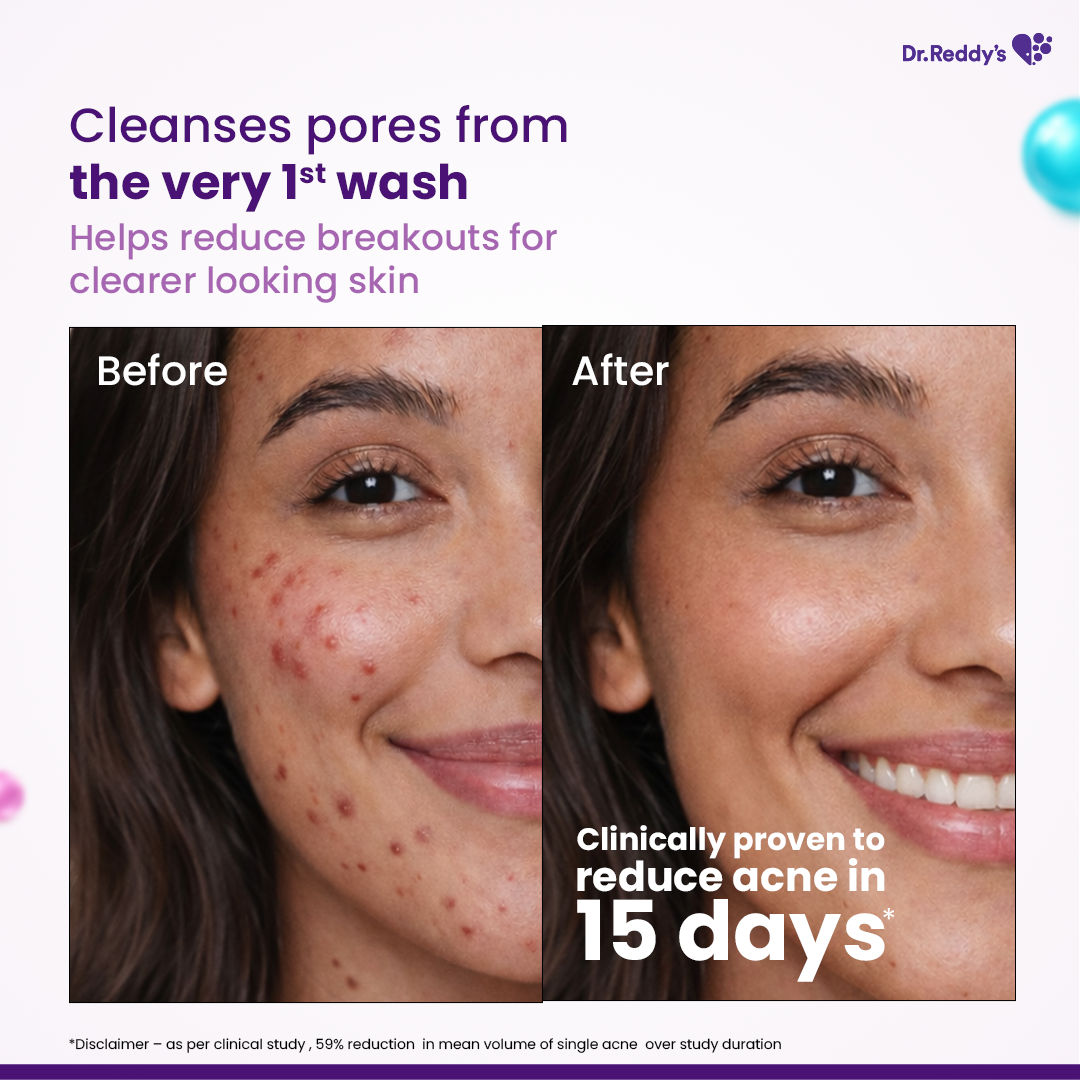 Acne Facewash With Sebum Control & Hydrating Formula