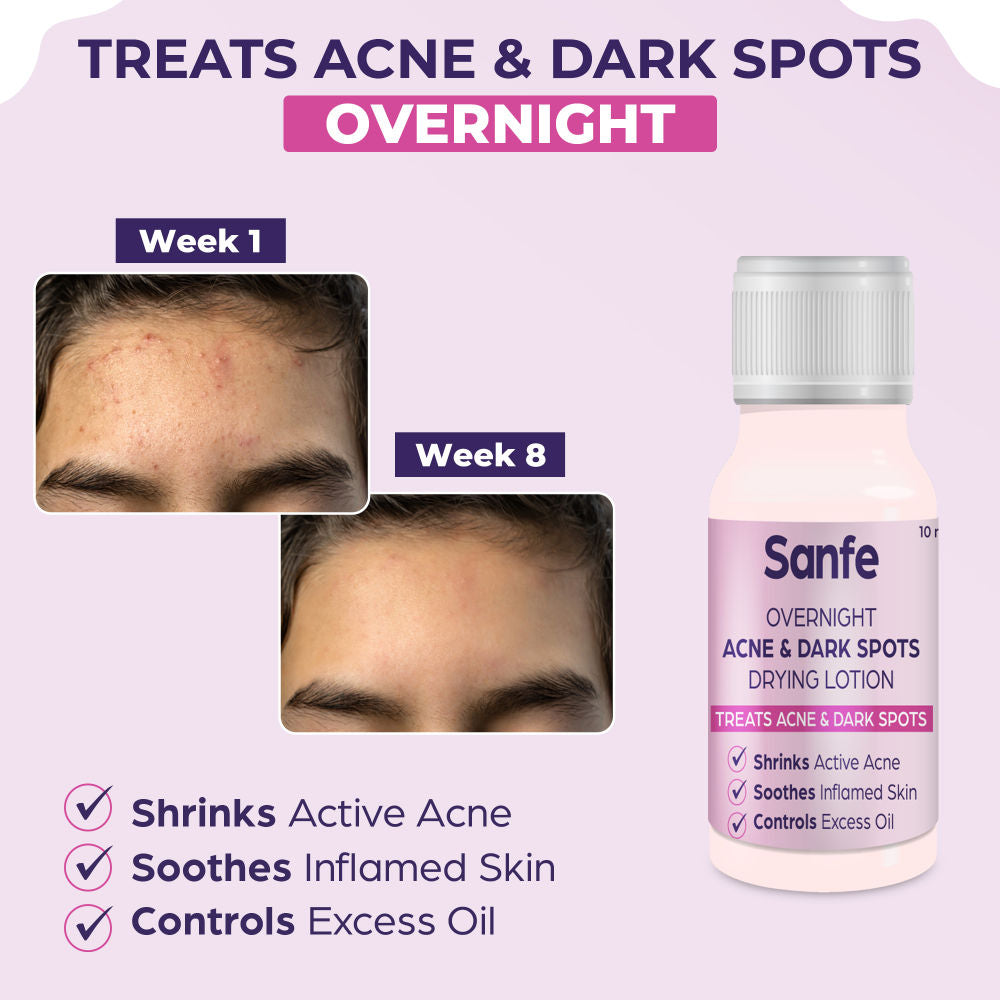 Overnight Acne Drying Lotion, Salicylic Acid & Calamine Acne Spot Corrector, Pimple Clearing