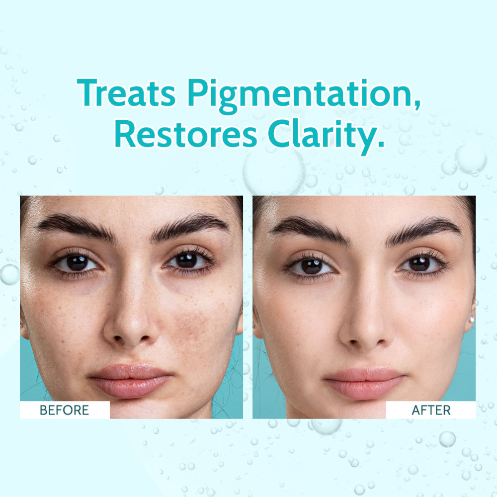 Clarifying Serum, 10% Niacinamide, 3% Tranexamic Acid, For Clear & Spotless Skin