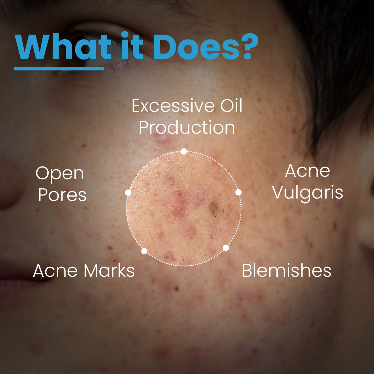 FCL Alpha Beta Acne Gel Adapalene with Glycolic Acid Treats Acne Pores For All Skin Types
